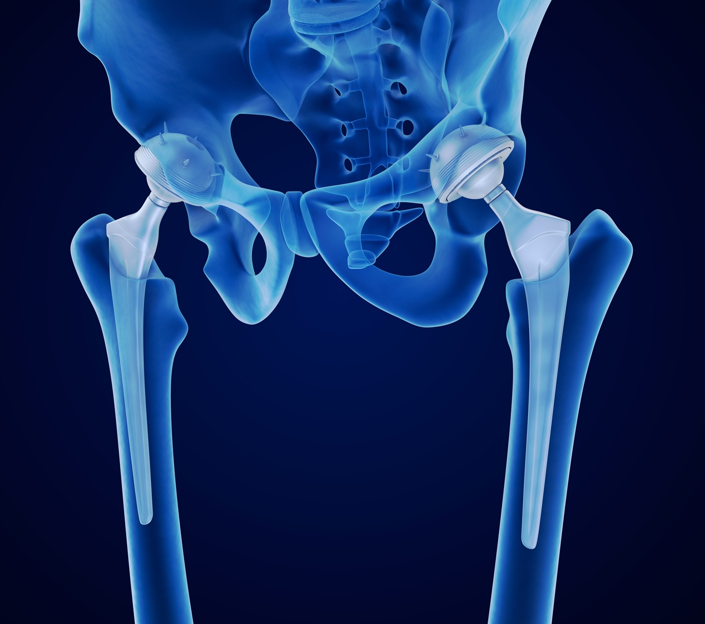 hip-replacement